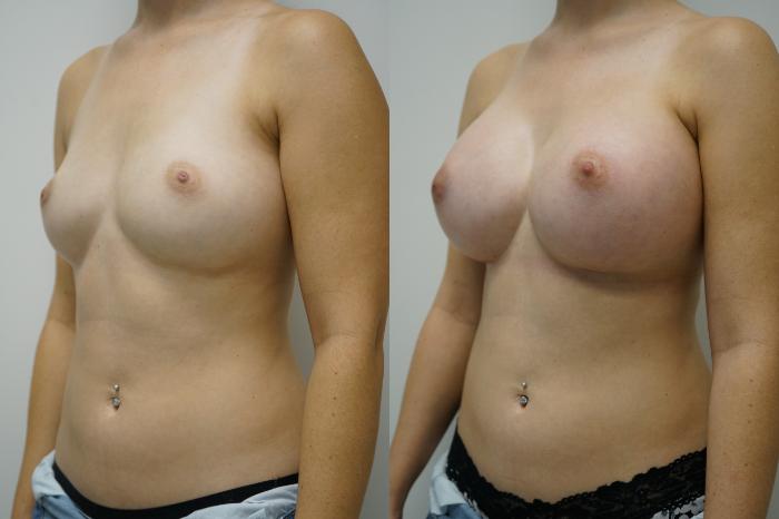 Before & After Breast Augmentation Case 393 Left Oblique View in Gilbert, AZ