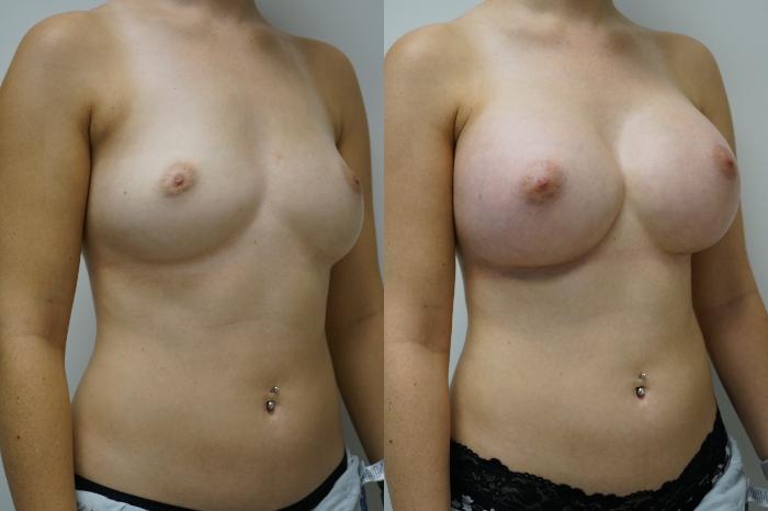 Before & After Breast Augmentation Case 393 Right Oblique View in Gilbert, AZ