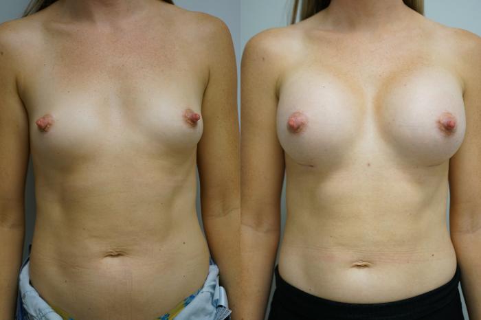 Before & After Breast Augmentation Case 395 Front View in Gilbert, AZ