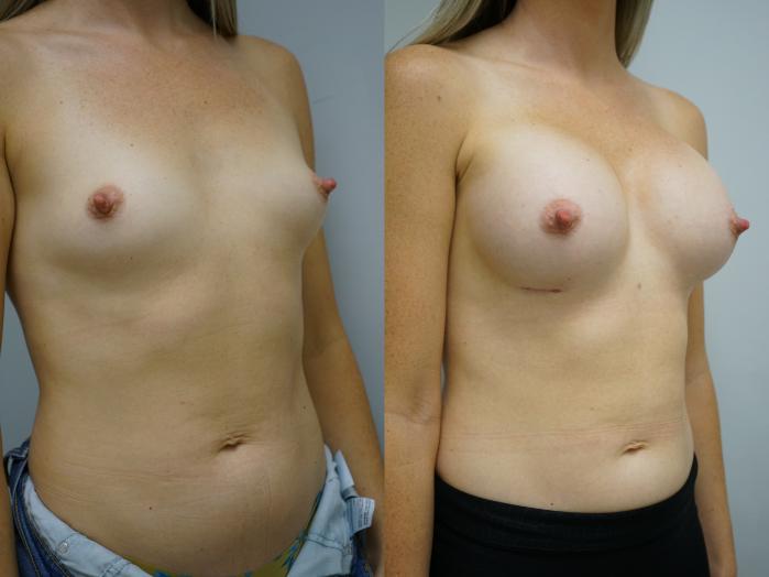 Before & After Breast Augmentation Case 395 Right Oblique View in Gilbert, AZ