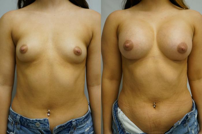 Before & After Breast Augmentation Case 396 Front View in Gilbert, AZ