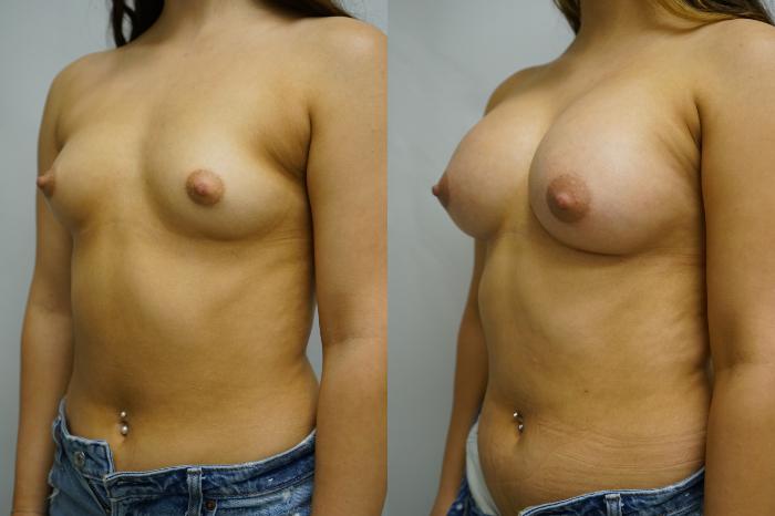 Before & After Breast Augmentation Case 396 Left Oblique View in Gilbert, AZ