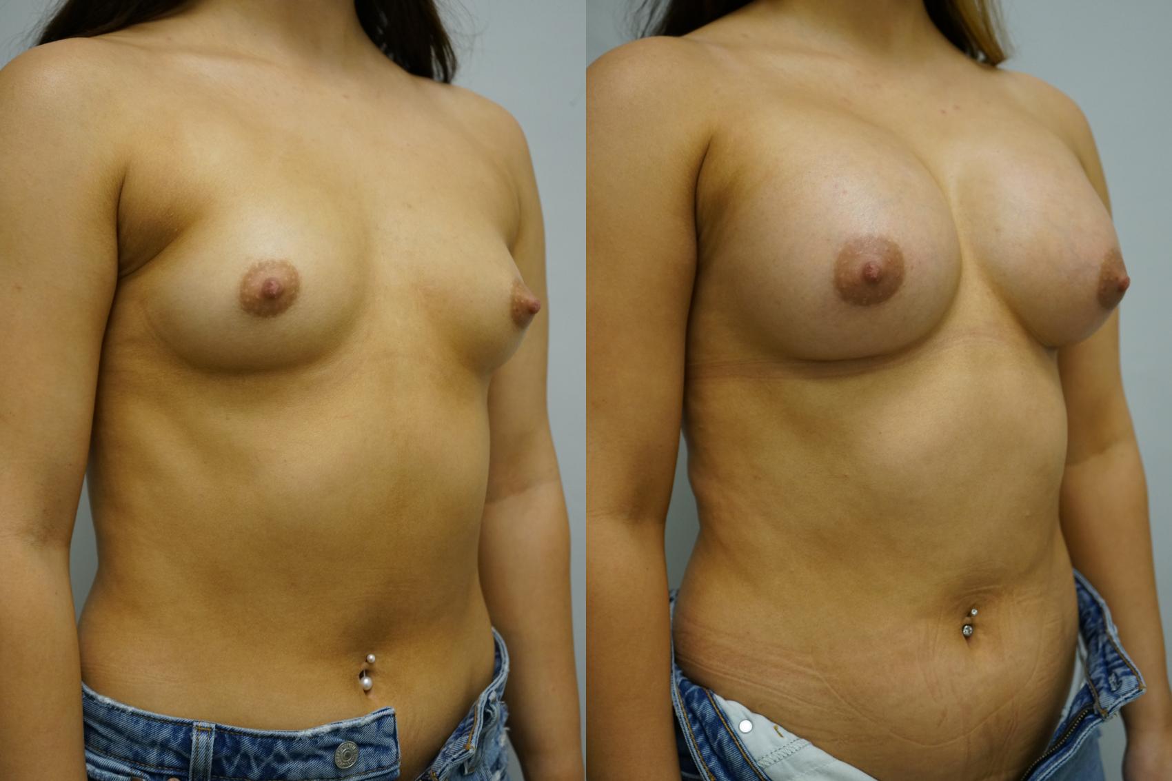 Before & After Breast Augmentation Case 396 Right Oblique View in Gilbert, AZ