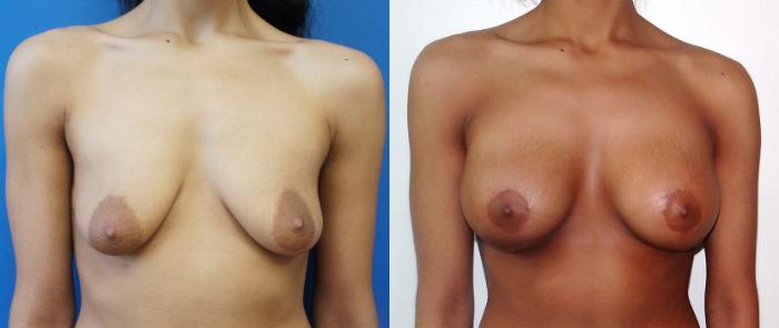 Before & After Breast Augmentation Case 4 View #1 View in Gilbert, AZ