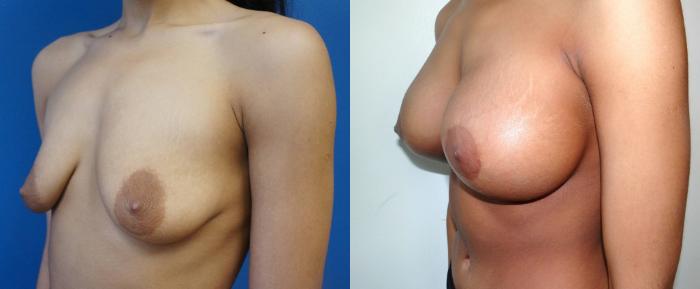 Before & After Breast Augmentation Case 4 View #2 View in Gilbert, AZ
