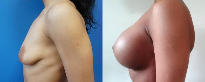 Before & After Breast Augmentation Case 4 View #3 View in Gilbert, AZ
