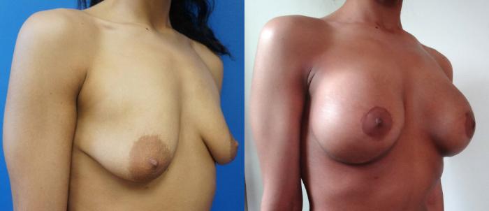 Before & After Breast Augmentation Case 4 View #4 View in Gilbert, AZ