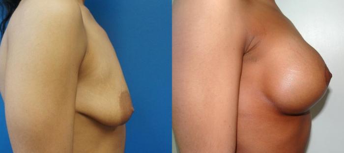 Before & After Breast Augmentation Case 4 View #5 View in Gilbert, AZ