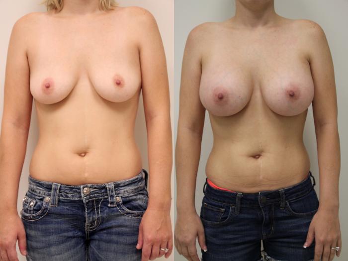 Before & After Breast Augmentation Case 40 View #1 View in Gilbert, AZ