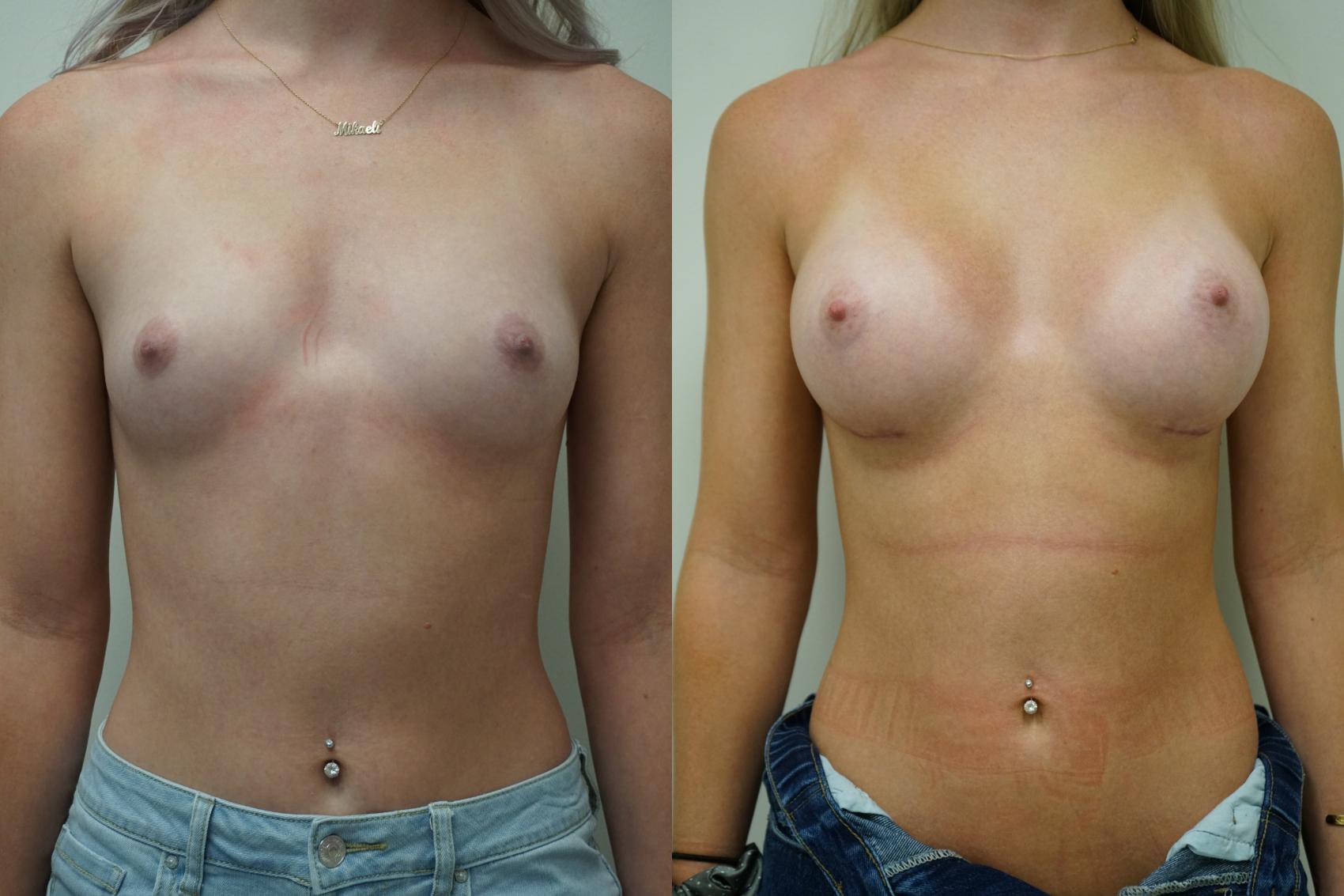 Before & After Breast Augmentation Case 400 Front View in Gilbert, AZ
