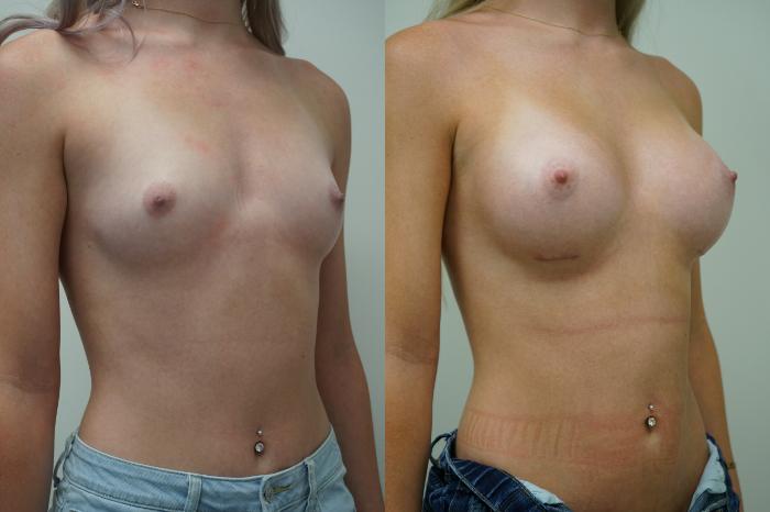 Before & After Breast Augmentation Case 400 Right Oblique View in Gilbert, AZ