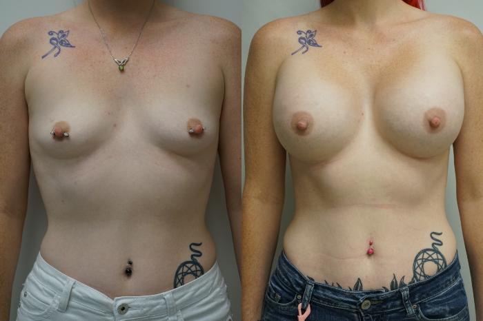 Before & After Breast Augmentation Case 403 Front View in Gilbert, AZ