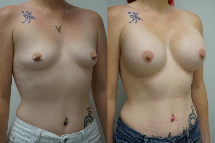Before & After Breast Augmentation Case 403 Right Oblique View in Gilbert, AZ