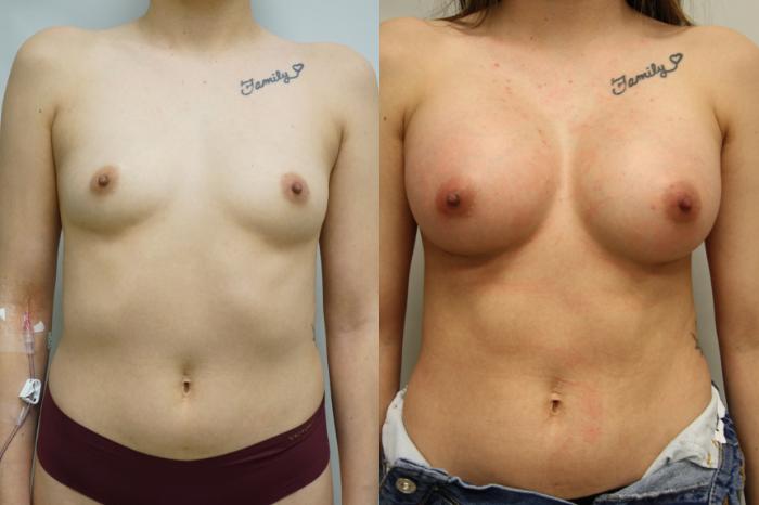 Before & After Breast Augmentation Case 404 Front View in Gilbert, AZ