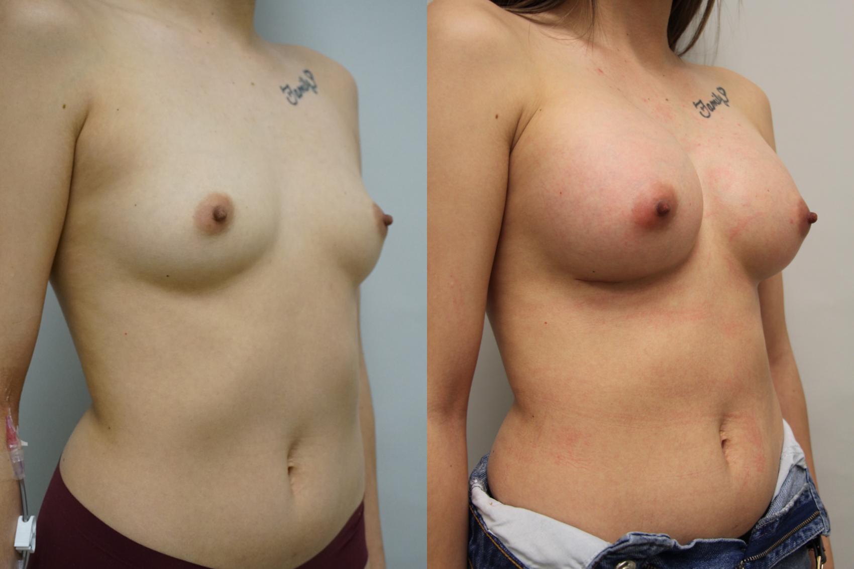 Before & After Breast Augmentation Case 404 Right Oblique View in Gilbert, AZ