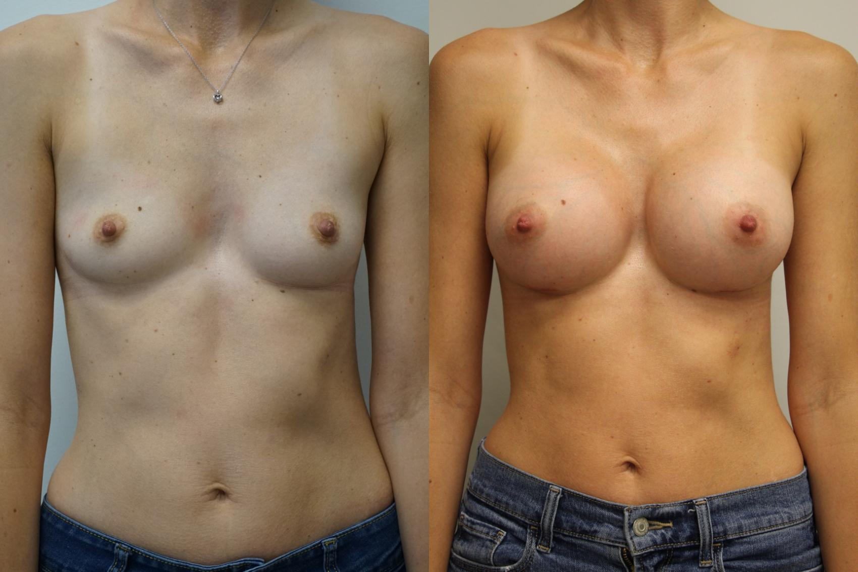 Before & After Breast Augmentation Case 405 Front View in Gilbert, AZ