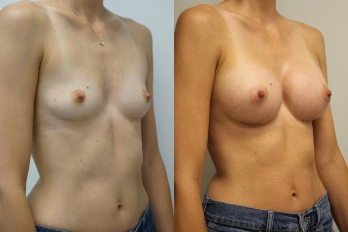 Before & After Breast Augmentation Case 405 Right Oblique View in Gilbert, AZ