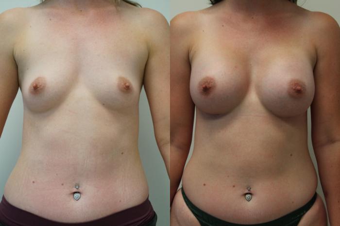 Before & After Breast Augmentation Case 409 Front View in Gilbert, AZ