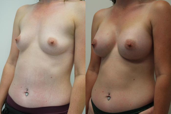 Before & After Breast Augmentation Case 409 Left Oblique View in Gilbert, AZ