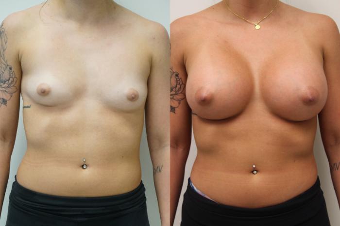 Before & After Breast Augmentation Case 410 Front View in Gilbert, AZ