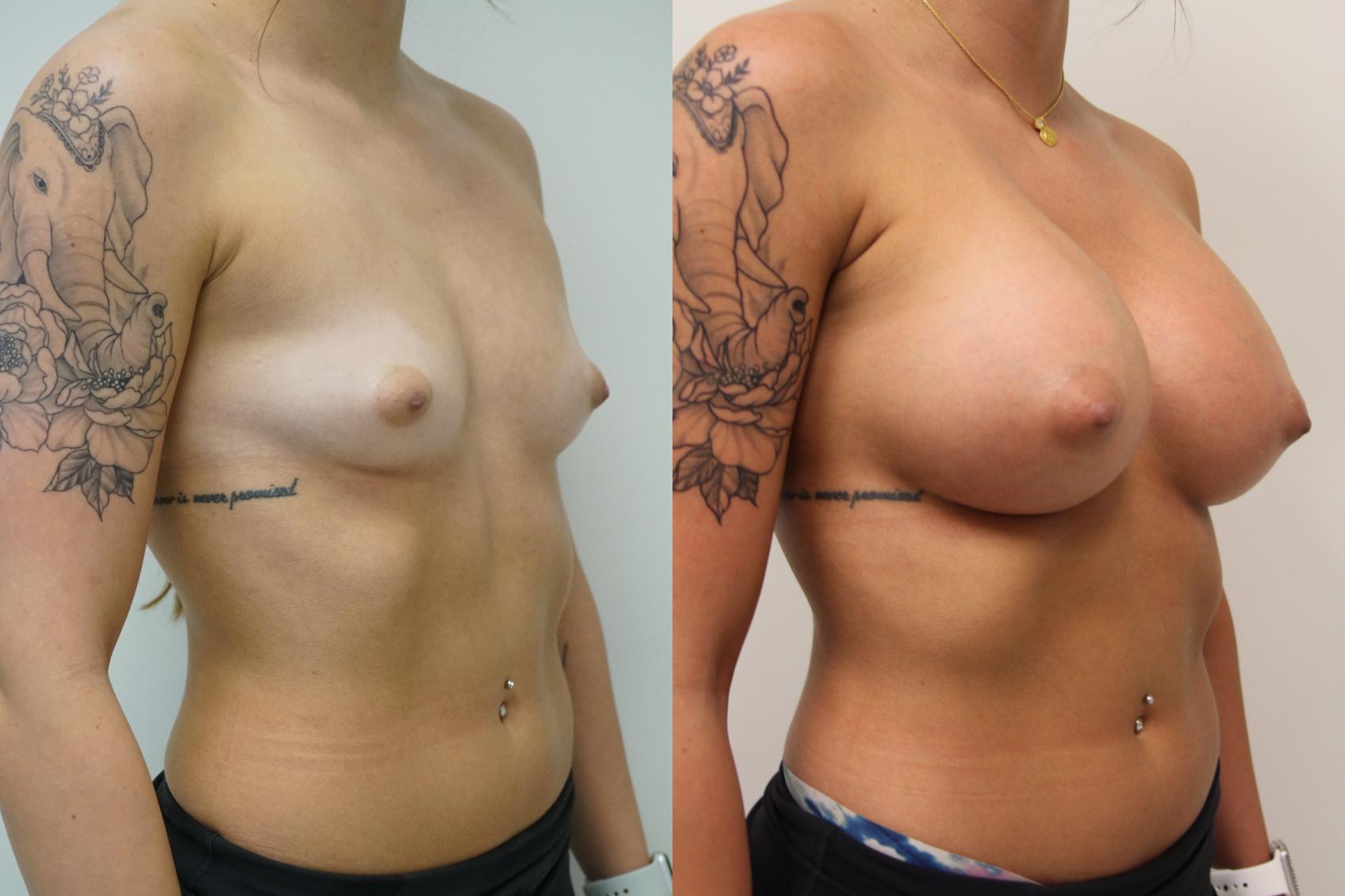 Before & After Breast Augmentation Case 410 Right Oblique View in Gilbert, AZ