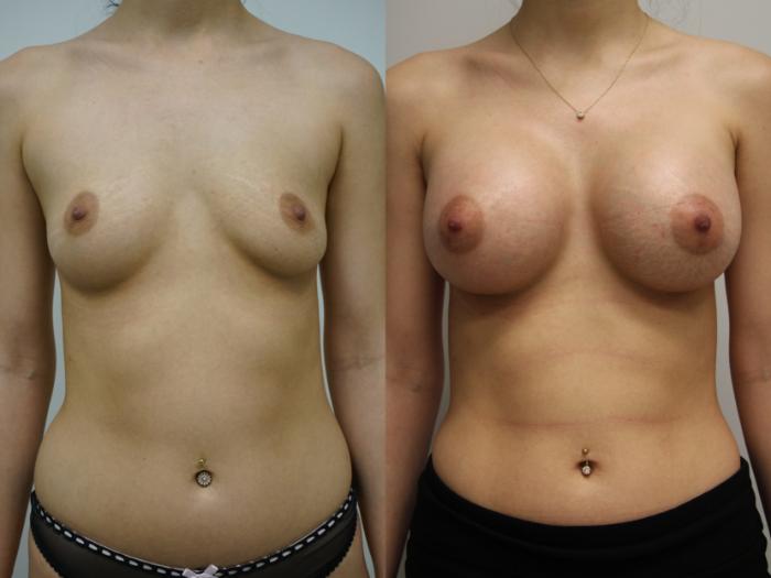 Before & After Breast Augmentation Case 411 Front View in Gilbert, AZ