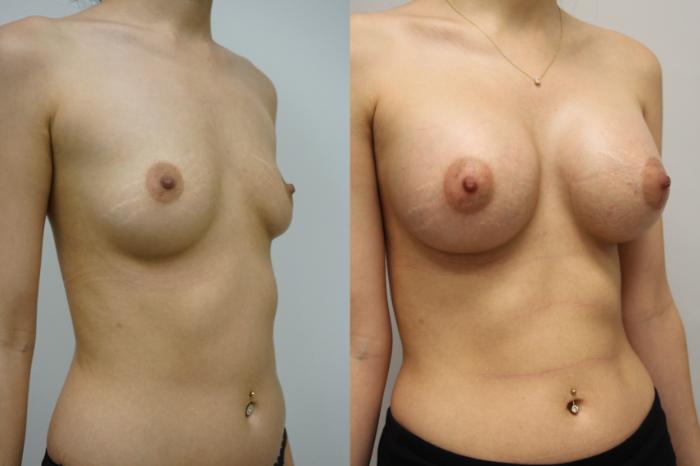 Before & After Breast Augmentation Case 411 Right Oblique View in Gilbert, AZ