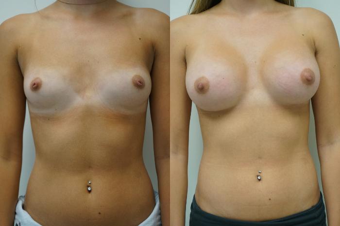 Before & After Breast Augmentation Case 413 Front View in Gilbert, AZ