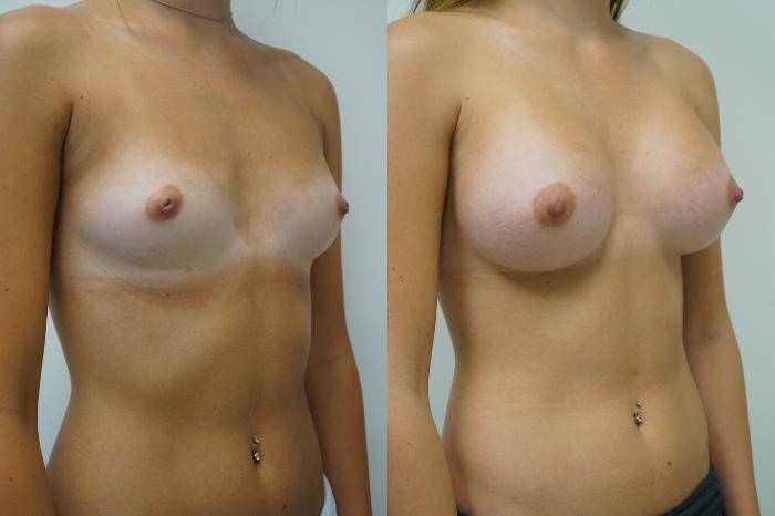 Before & After Breast Augmentation Case 413 Right Oblique View in Gilbert, AZ