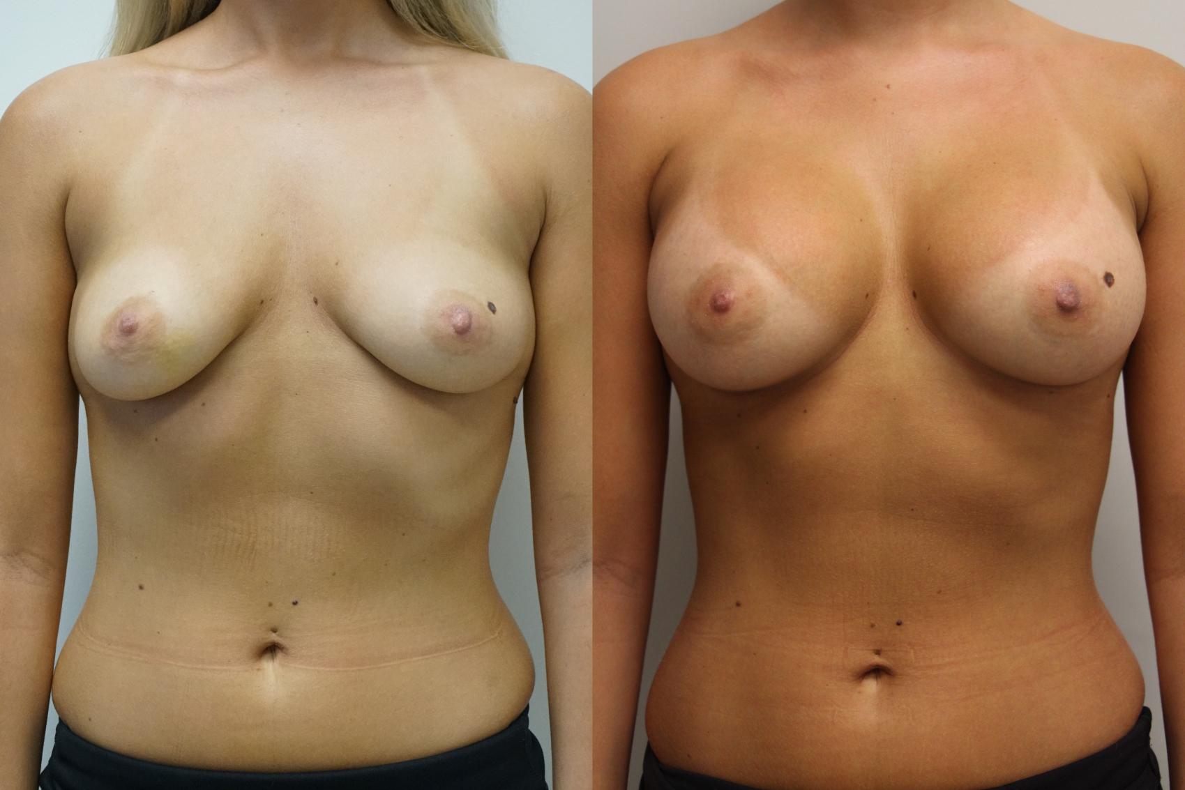 Before & After Breast Augmentation Case 414 Front View in Gilbert, AZ