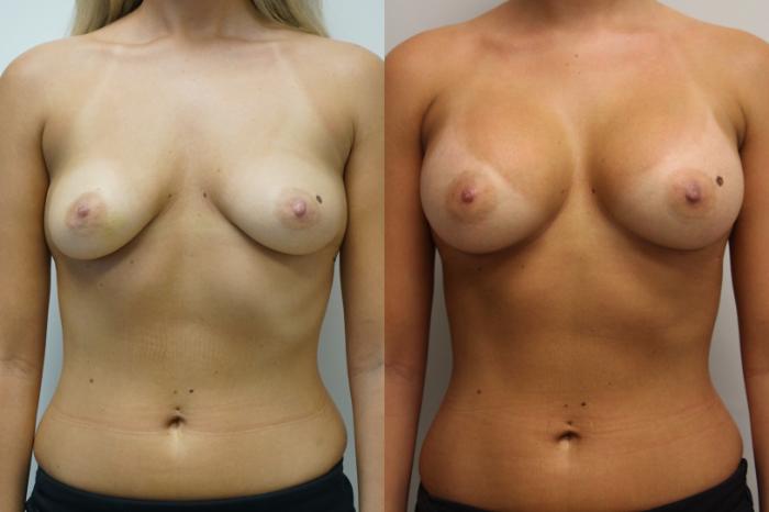 Before & After Breast Augmentation Case 414 Front View in Gilbert, AZ