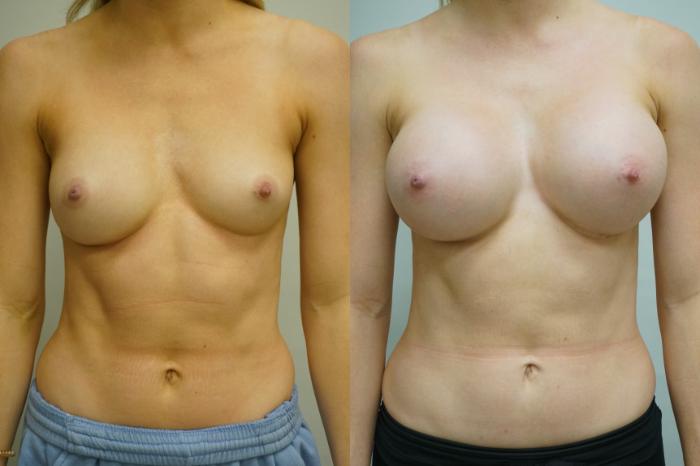 Before & After Breast Augmentation Case 415 Front View in Gilbert, AZ