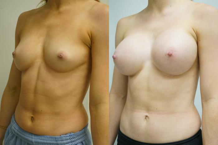 Before & After Breast Augmentation Case 415 Left Oblique View in Gilbert, AZ