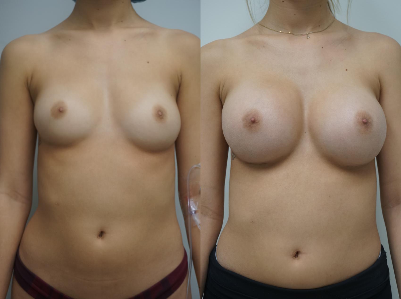 Before & After Breast Augmentation Case 416 Front View in Gilbert, AZ