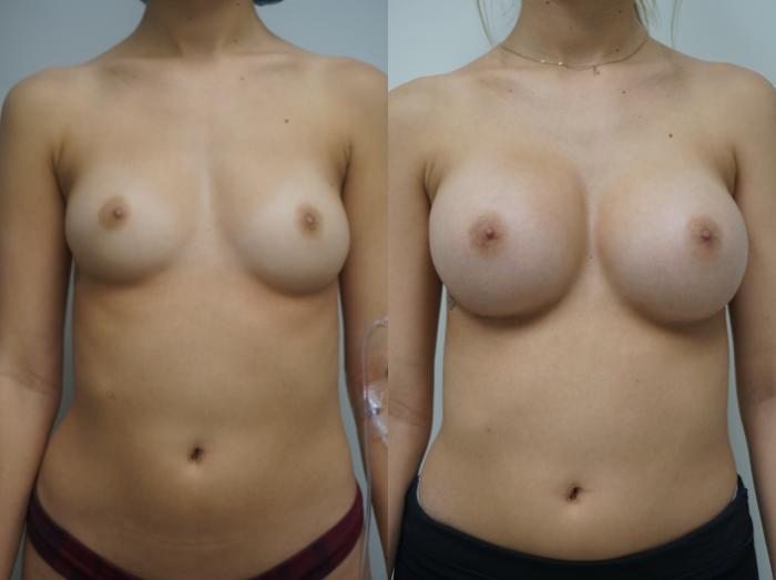 Before & After Breast Augmentation Case 416 Front View in Gilbert, AZ