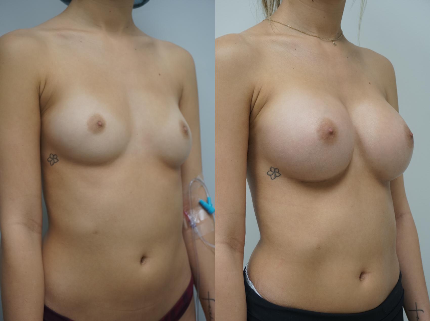 Before & After Breast Augmentation Case 416 Right Oblique View in Gilbert, AZ
