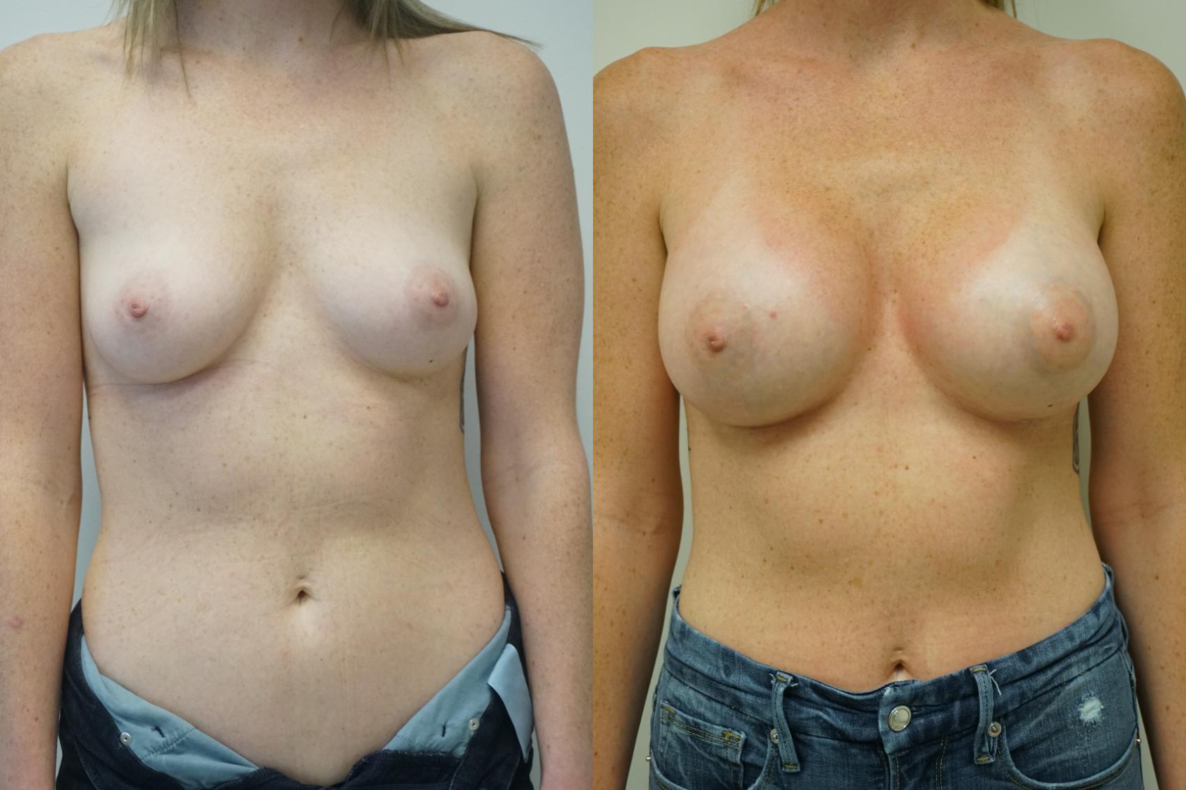 Before & After Breast Augmentation Case 418 Front View in Gilbert, AZ
