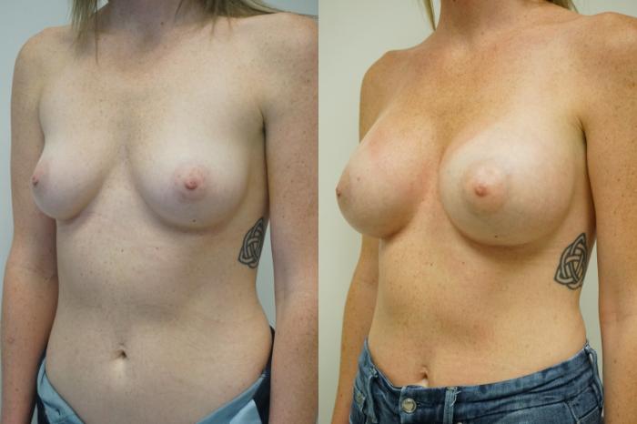 Before & After Breast Augmentation Case 418 Left Oblique View in Gilbert, AZ