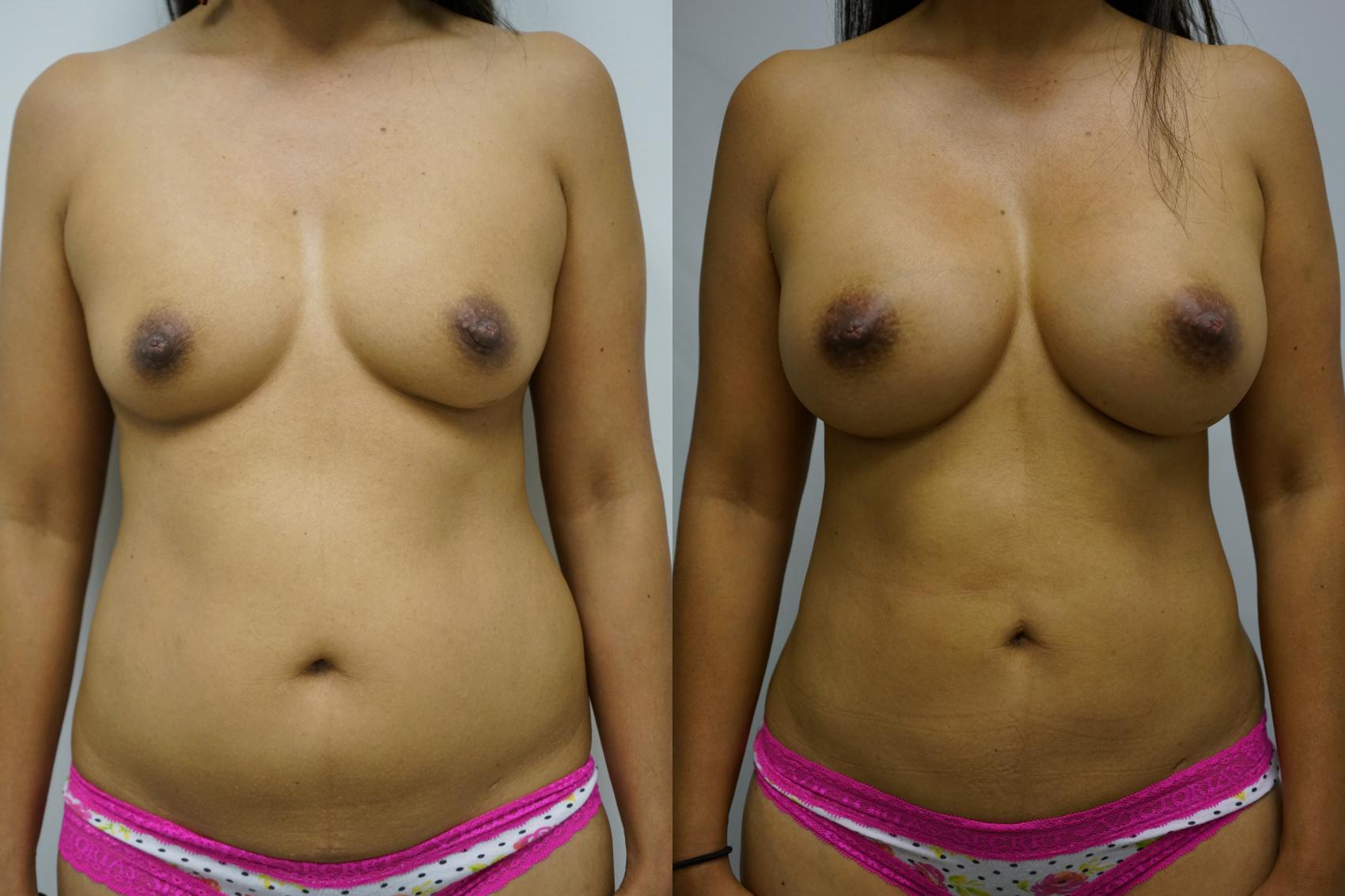Before & After Breast Augmentation Case 419 Front View in Gilbert, AZ