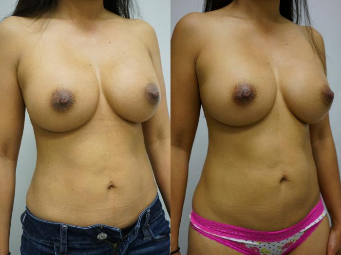 Before & After Breast Augmentation Case 419 Right Oblique View in Gilbert, AZ