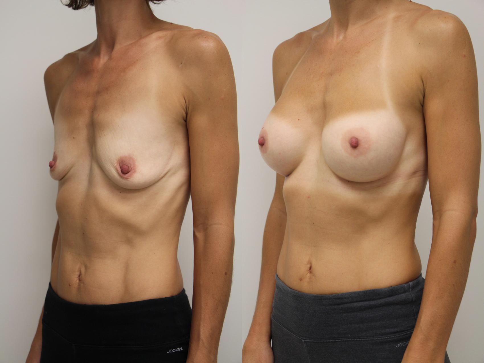 Before & After Breast Augmentation Case 42 View #1 View in Gilbert, AZ