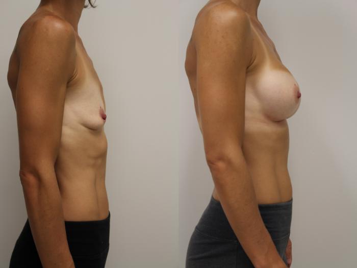 Before & After Breast Augmentation Case 42 View #2 View in Gilbert, AZ