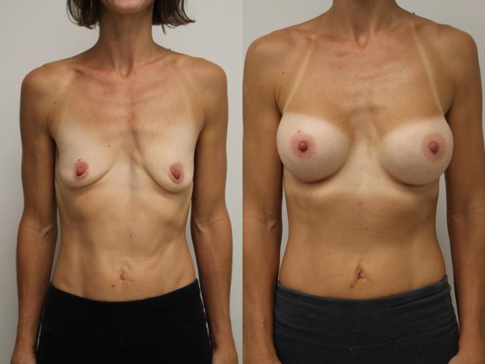 Before & After Breast Augmentation Case 42 View #3 View in Gilbert, AZ
