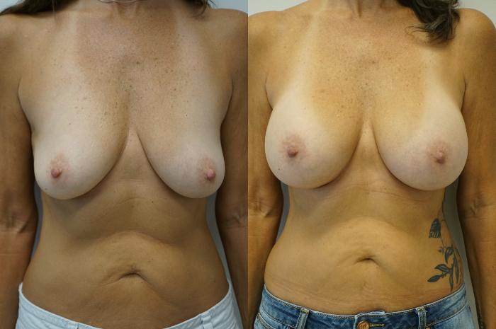 Before & After Breast Augmentation Case 422 Front View in Gilbert, AZ
