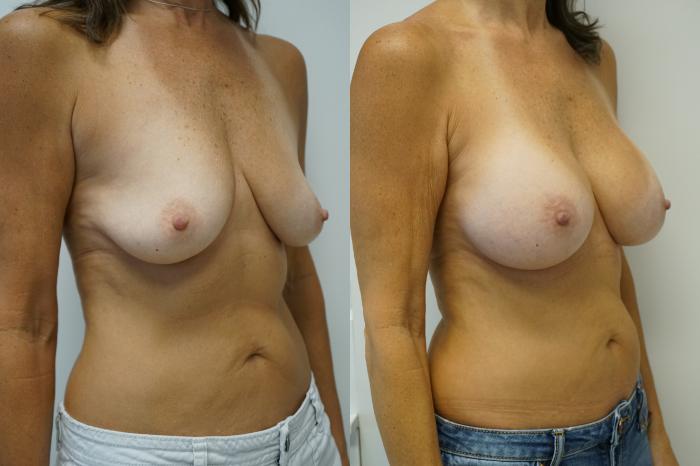 Before & After Breast Augmentation Case 422 Right Oblique View in Gilbert, AZ