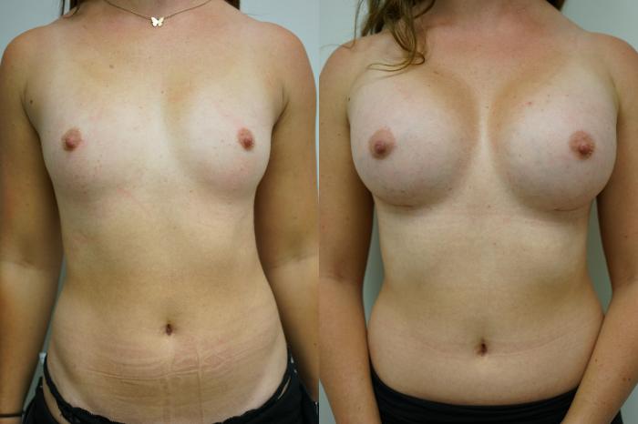 Before & After Breast Augmentation Case 429 Front View in Gilbert, AZ