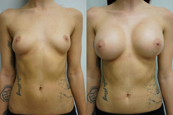 Before & After Breast Augmentation Case 432 Front View in Gilbert, AZ