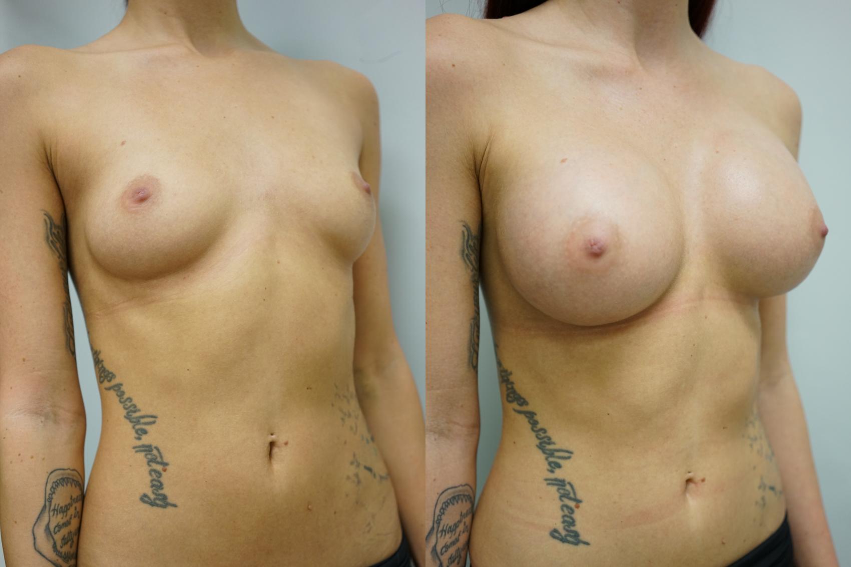 Before & After Breast Augmentation Case 432 Right Oblique View in Gilbert, AZ
