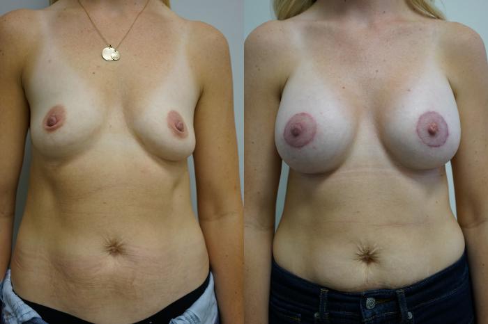 Before & After Breast Augmentation Case 433 Front View in Gilbert, AZ