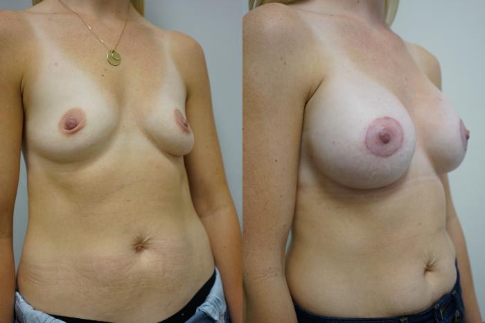 Before & After Breast Augmentation Case 433 Right Oblique View in Gilbert, AZ